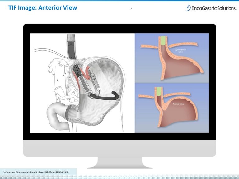 Training and Education in TIF Procedure EndoGastric Solutions
