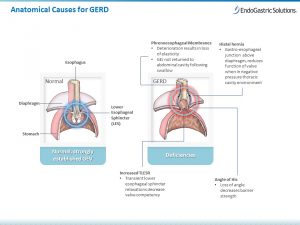 Hiatal Hernia Repair followed by TIF procedure
