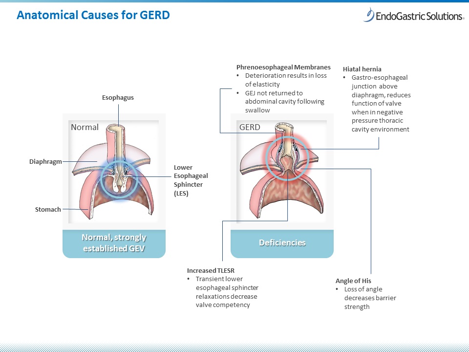 EndoGastric Solutions Announces 12-month Data Validating Hiatal Hernia Repair Prior to Transoral Incisionless Fundoplication (TIF®) as a Durable GERD Treatment Option