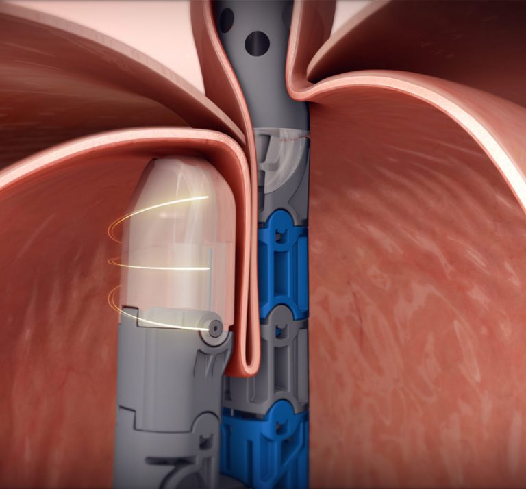 EndoGastric® Solutions Debuts EsophyX® Z+ Device for Transoral