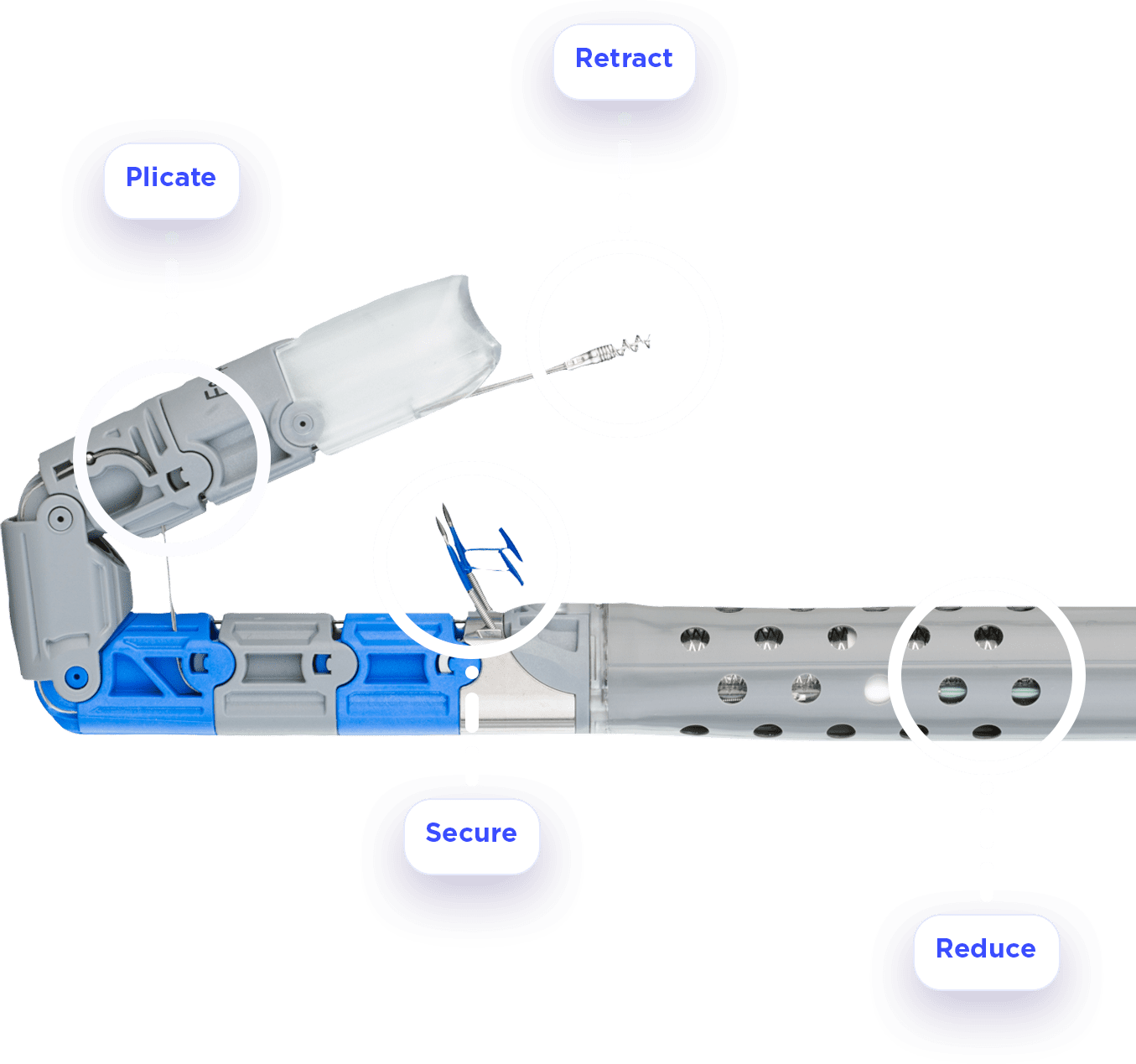 Esophyx Device