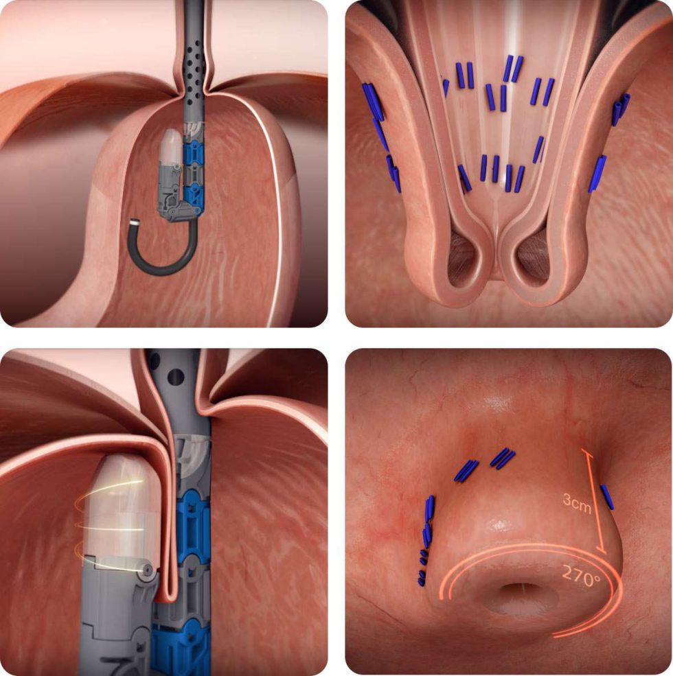 EndoGastric Solutions a leader in the endoluminal treatment of digestive diseases